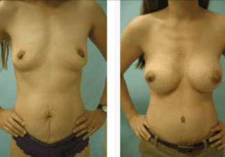 Abdominoplasty