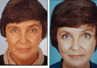 Blepharoplasty-Gallery-Cases-McKinnon-Plastic-Surgery-11-04-2024_01_02_PM