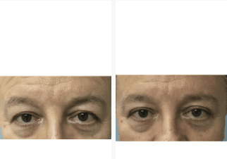 Blepharoplasty-Gallery-Cases-McKinnon-Plastic-Surgery-11-04-2024_11_11_AM