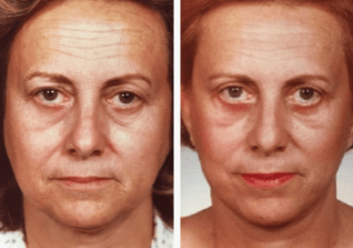 Blepharoplasty-Gallery-Cases-McKinnon-Plastic-Surgery-11-04-2024_11_20_AM