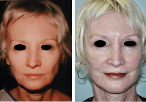 Blepharoplasty-Gallery-Cases-McKinnon-Plastic-Surgery-11-04-2024_11_24_AM