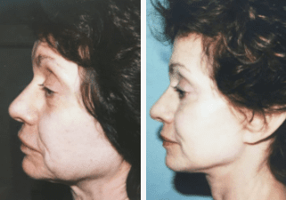 Blepharoplasty-Gallery-Cases-McKinnon-Plastic-Surgery-11-04-2024_11_32_AM