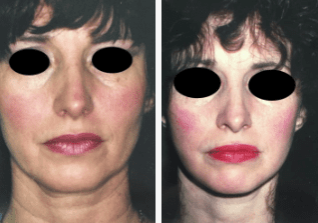 Blepharoplasty-Gallery-Cases-McKinnon-Plastic-Surgery-11-04-2024_12_10_PM