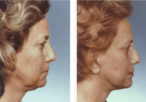 Blepharoplasty-Gallery-Cases-McKinnon-Plastic-Surgery-11-04-2024_12_17_PM