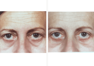 Blepharoplasty-Gallery-Cases-McKinnon-Plastic-Surgery-11-04-2024_12_31_PM