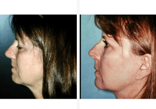 Blepharoplasty-Gallery-Cases-McKinnon-Plastic-Surgery-11-04-2024_12_57_PM