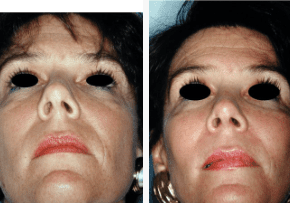 Browlift-Gallery-Cases-McKinnon-Plastic-Surgery-11-04-2024_07_26_PM