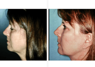 Browlift-Gallery-Cases-McKinnon-Plastic-Surgery-11-04-2024_08_04_PM