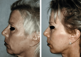 Browlift-Gallery-Cases-McKinnon-Plastic-Surgery-11-04-2024_08_10_PM