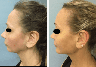 Facial-Bone-Augmentation-Gallery-Cases-McKinnon-Plastic-Surgery-11-04-2024_05_51_PM