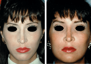 Facial-Bone-Augmentation-Gallery-Cases-McKinnon-Plastic-Surgery-11-04-2024_05_57_PM